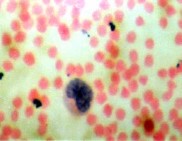 chất bắt màu đỏ nhạt chứa nhiều hạt trung tính bắt màu đỏ xen lẫn màu 4