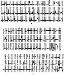 Flack đến nốt Aschoff Tawara QRS là sóng tổng hợp của tâm thất Đoạn S T tương 3