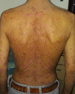 HÌNH ẢNH MỘT SỐ BỆNH NHÂN TRƯỚC VÀ SAU ĐIỀU TRỊ KHI ĐẠT PASI 75 Trước 2