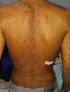 HÌNH ẢNH MỘT SỐ BỆNH NHÂN TRƯỚC VÀ SAU ĐIỀU TRỊ KHI ĐẠT PASI 75 Trước 3