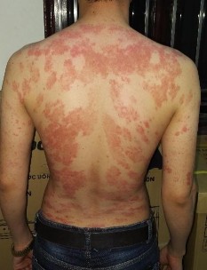 Trước điều trị Dương Văn M nam 22t Đạt PASI 75 sau 19 lần chiếu Dương Văn M 4