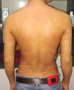 Trước điều trị Dương Văn M nam 22t Đạt PASI 75 sau 19 lần chiếu Dương Văn M 5