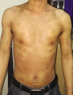 Trước điều trị Nguyễn Tiến T nam 23t Đạt PASI 75 sau 20 lần chiếu Nguyễn 1