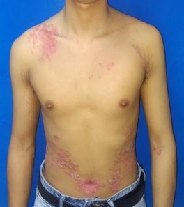 HÌNH ẢNH MỘT SỐ BỆNH NHÂN TRƯỚC VÀ SAU ĐIỀU TRỊ KHÔNG ĐẠT PASI 75 Trước 10