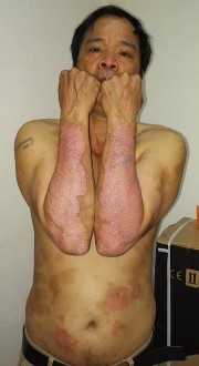 Trước điều trị PASI 12 5 Ngô Duy B nam 54 tuổi Sau 36 lần chiếu PASI 6 2 PASI 50 11