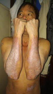 Trước điều trị PASI 12 5 Ngô Duy B nam 54 tuổi Sau 36 lần chiếu PASI 6 2 PASI 50 12