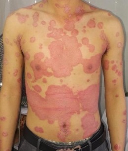 Trước điều trị Nguyễn Tiến T nam 23t Đạt PASI 75 sau 20 lần chiếu Nguyễn 2