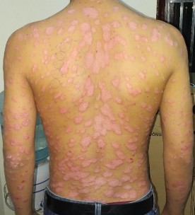 Trước điều trị Nguyễn Tiến T nam 23t Đạt PASI 75 sau 20 lần chiếu Nguyễn 3