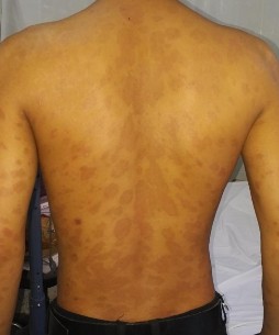 Trước điều trị Nguyễn Tiến T nam 23t Đạt PASI 75 sau 20 lần chiếu Nguyễn 4