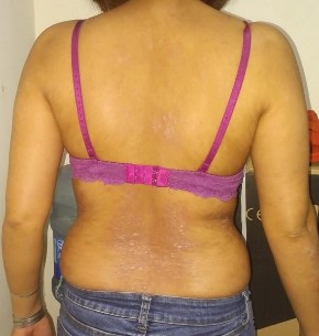 Trước điều trị Trần Thị Phương L nữ 30t Đạt PASI 75 sau 14 lần chiếu Trần 5