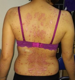 Trước điều trị Trần Thị Phương L nữ 30t Đạt PASI 75 sau 14 lần chiếu Trần 6