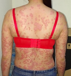 Trước điều trị Trần Thị Phương L nữ 30t Đạt PASI 75 sau 14 lần chiếu Trần 7