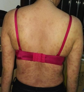 Trước điều trị Trần Thị Phương L nữ 30t Đạt PASI 75 sau 14 lần chiếu Trần 8