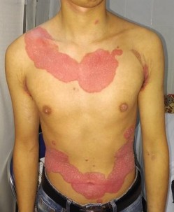 HÌNH ẢNH MỘT SỐ BỆNH NHÂN TRƯỚC VÀ SAU ĐIỀU TRỊ KHÔNG ĐẠT PASI 75 Trước 9