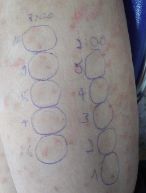 Hình 2 1 Bệnh nhân trước và sau 24 giờ sau đo liều MED bằng máy Medisun Gigatest 1 1