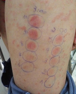 Hình 2 1 Bệnh nhân trước và sau 24 giờ sau đo liều MED bằng máy Medisun Gigatest 1 2