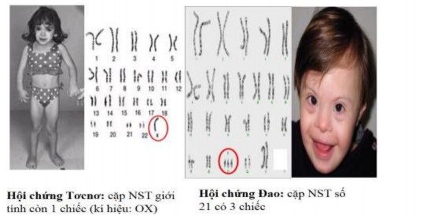 GV cho HS quan sát tranh một số loại bệnh do đột biến NST  SP cần đạt sau khi 1