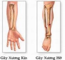 Hình 8 1 Gãy xương 3 Dấu hiệu chính của gãy xương Đau nhức nơi gãy xương Mất 5