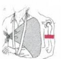 Hình 8 2 Cố định vào th n bằng băng tam giác Hình 8 3 Cố định bằng nẹp 5 2 2 6