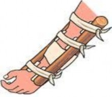 Hình 8 4 Cố định gãy xương cẳng tay bằng nẹp Hình 8 5 Cố định gãy xương 8