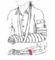 Hình 8 4 Cố định gãy xương cẳng tay bằng nẹp Hình 8 5 Cố định gãy xương 9