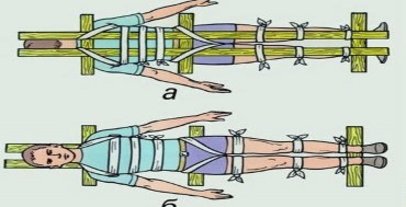 Hình 5 11 Cố định gãy xương cột sống MỤC TIÊU Bài 12 CẤP CỨU NGỪNG HÔ HẤP 3