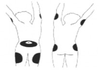 Các vùng tiêm dưới da Kỹ thuật tiêm dưới da BẢNG KIỂM KỸ THUẬT TIÊM DƯỚI 1