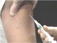 Các vùng tiêm dưới da Kỹ thuật tiêm dưới da BẢNG KIỂM KỸ THUẬT TIÊM DƯỚI 2