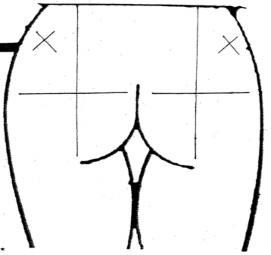 Vùng tiêm mông Vùng tiêm cánh tay cơ delta Vùng tiêm đùi 1 3 giữa mặt ngoài 6 3 4 3