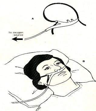 Thở ôxy kính mũi Điều dưỡng rửa tay Kiểm tra lại dụng cụ và mang đến 1