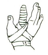 Hình Băng một ngón Băng kín 5 ngón Băng 2 vòng ở cổ tay vòng khóa 6