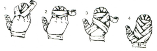 Hình Băng kín bàn tay Băng bàn tay để hở ngón Băng 2 vòng ở khớp đốt bàn và 2