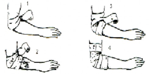 Hình Băng khuỷu tay Vai Băng kiểu hình số 8 Băng 2 vòng khóa ở cánh tay sát nách 3