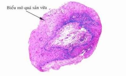 Hình 1 6 Biểu mô quá sản mức độ vừa mô đệm xơ hoá 42 1 4 5 Chẩn đoán xác 1