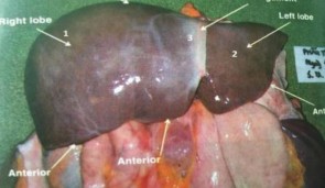 Hình 1 1 Hình thể ngoài của gan Nguồn Theo Frank Netter 1995 6 1 1 2 Mạch máu và 1