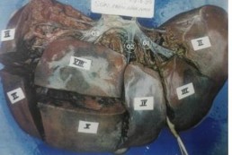 Hình 1 2 Sự phân chia các hạ phân thùy gan theo Tôn Thất Tùng Nguồn Trịnh Hồng 2