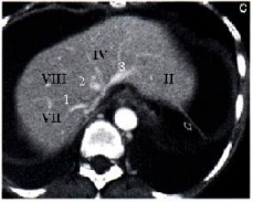 Hình 1 3 Lớp cắt cao phía trên thấy r 3 tĩnh mạch gan 1 TM gan phải 2 TM gan giữa 3 3