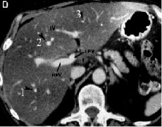 Hình 1 4 Lớp cắt ngang qua nhánh trái và nhánh phải của TMC Phía trên là HPT II IVa 5