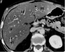 Hình 1 5 Lớp cắt qua phần thấp của gan qua các HPT III IVb V VI 11 7