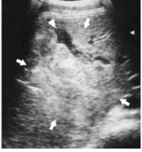Hình 1 6 Tụ máu trong nhu mô thùy gan phải mũi tên Nguồn Sato M Yoshii H 2004 15 Tuy 1