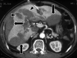 Hình 1 7 Tụ máu dưới bao gan có dạng hình liềm mũi tên dài hay thấu kính và 2