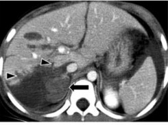 Hình 1 8 Rách gan và đụng dập – tụ máu nhu mô mũi tên ngắn vùng không có phúc 3