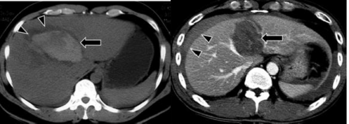 Hình 1 9 Tụ máu trong nhu mô trước và sau tiêm cản quang mũi tên Nguồn 4
