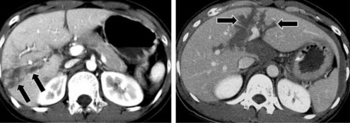 Hình 1 10 Đường rách nhu mô gan trên CLVT mũi tên Nguồn Shanmuganathan K Mirvis SE 21 5