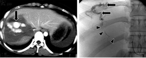 Hình 1 11 Tổn thương mạch máu mũi tên Nguồn Shanmuganathan K Mirvis SE 21 Tổn 6