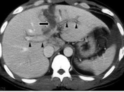 Hình 1 12 Tổn thương tĩnh mạch cửa trên phim CLVT mũi tên Nguồn Shanmuganathan K 7