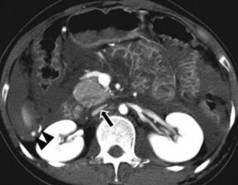 Hình 1 13 xẹp tĩnh mạch chủ dưới mũi tên có mạch đang chảy máu Nguồn 1