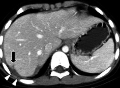 Hình 1 14 CTG độ I Rách nhu mô đường vỡ sâu 1cm mũi tên Nguồn Shanmuganathan K 2