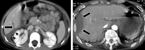 Hình 1 15 CTG độ II Rách nhu mô sâu 1 3 cm dài 10 cm mũi tên Hình 1 16 CTG độ II Tụ 3