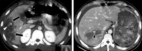 Hình 1 17 CTG độ III Tụ máu góc dưới thùy gan phải mũi tên 10cm Hình 1 18 CTG 4
